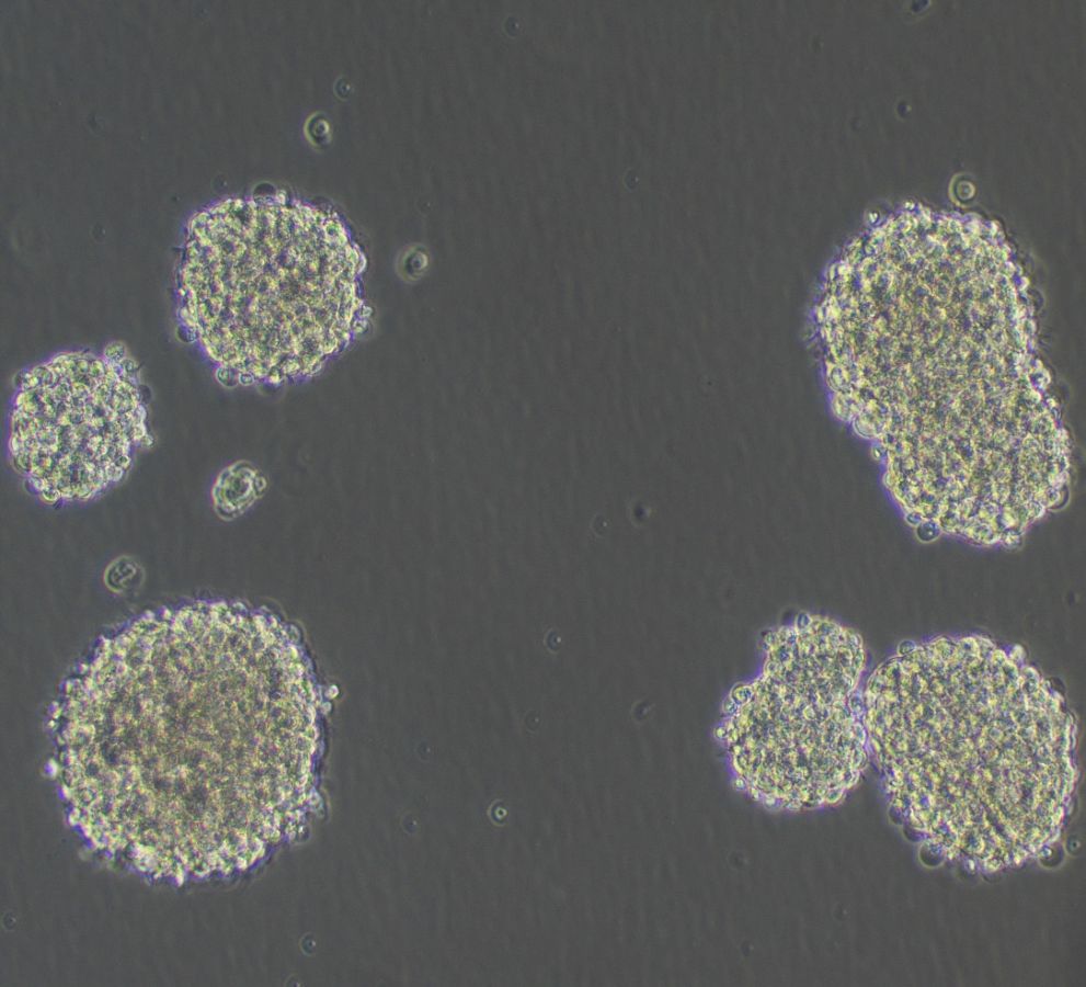 3D sarcoma model derived from patient tissue (Images: rights reserved)